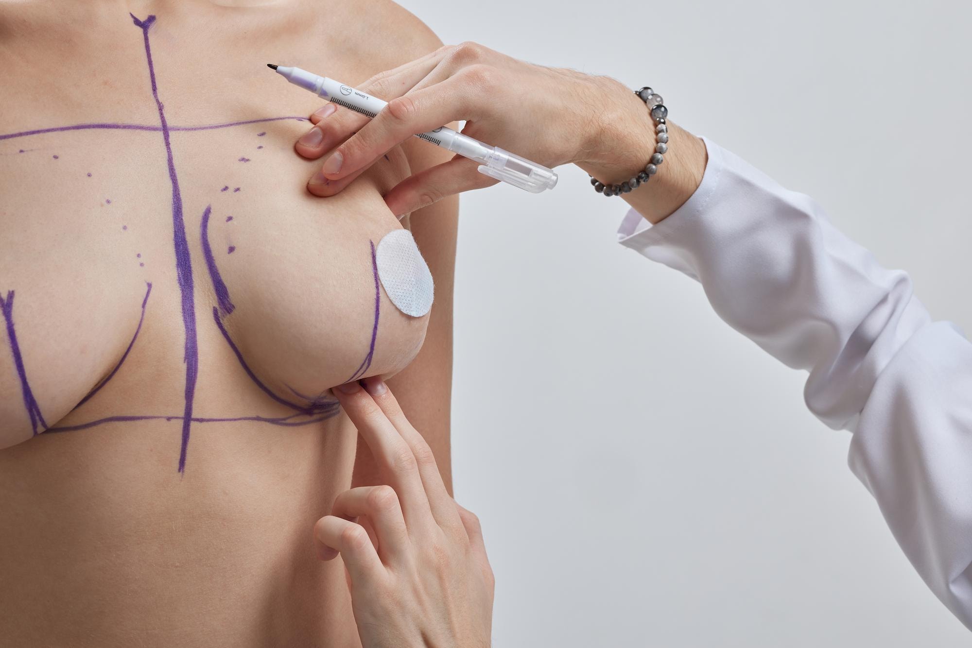 Breast Lift