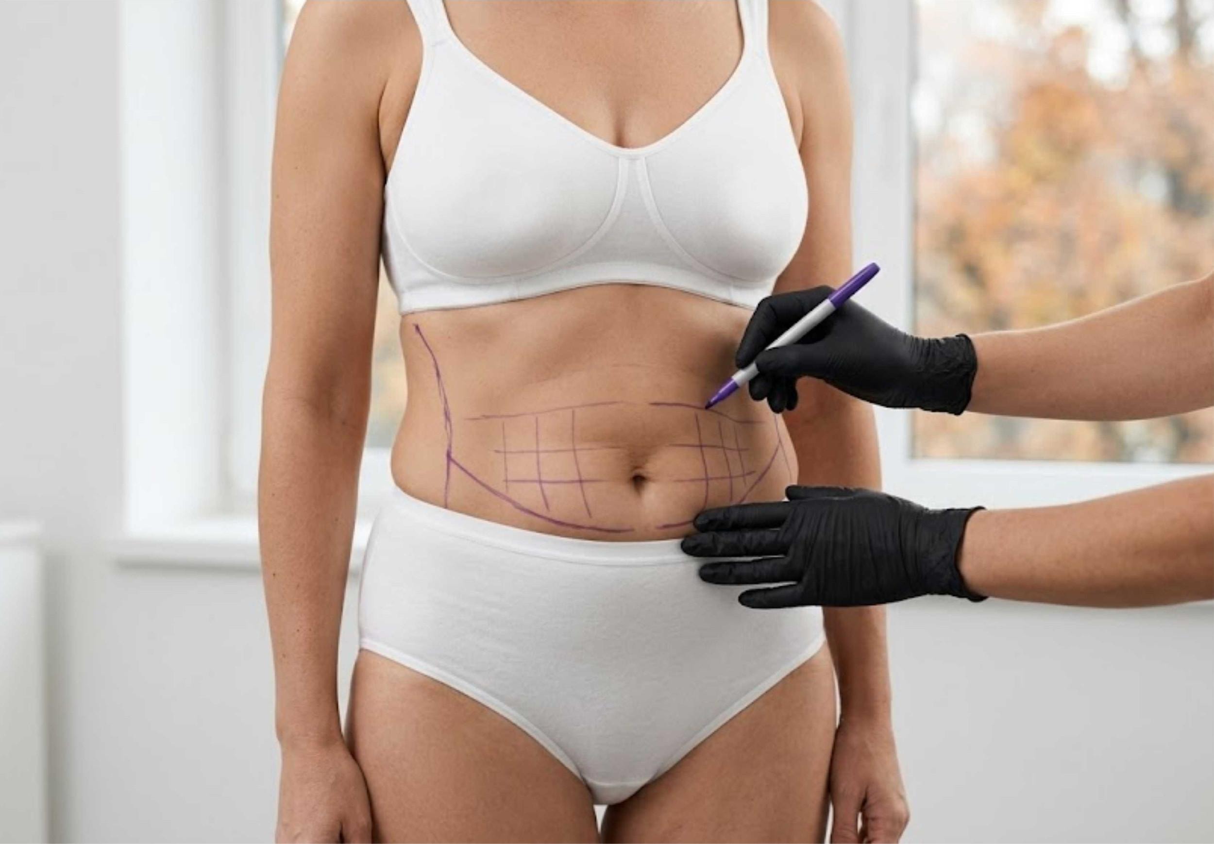 Liposuction